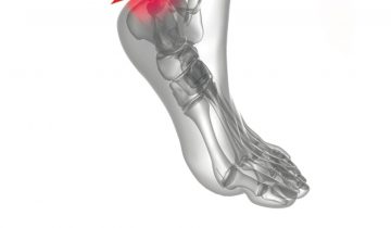 Inlegzolen Achilles Klachten Heren maat 42